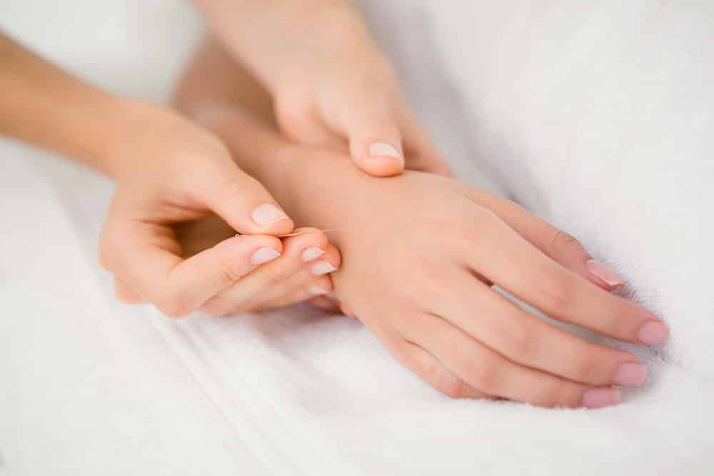Hand Akupunktur